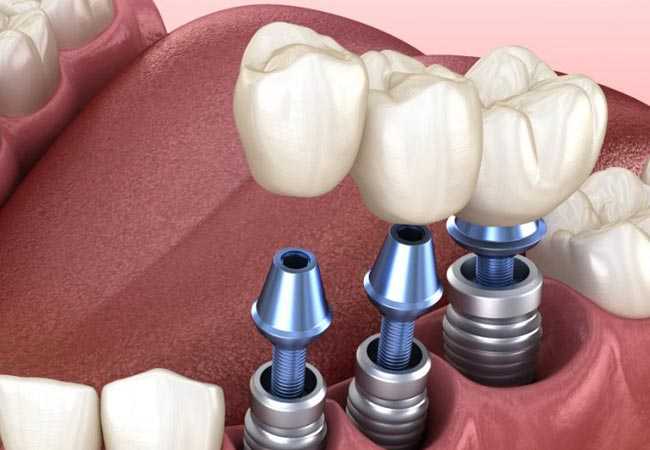 implant-tedavisi